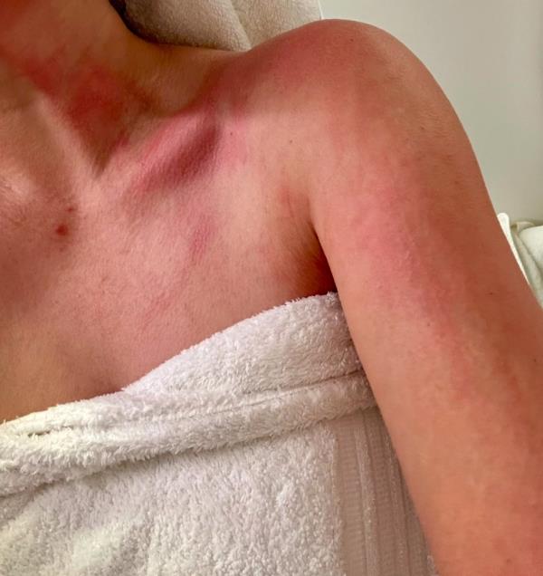 woman's arm and neck with red burn marks. 