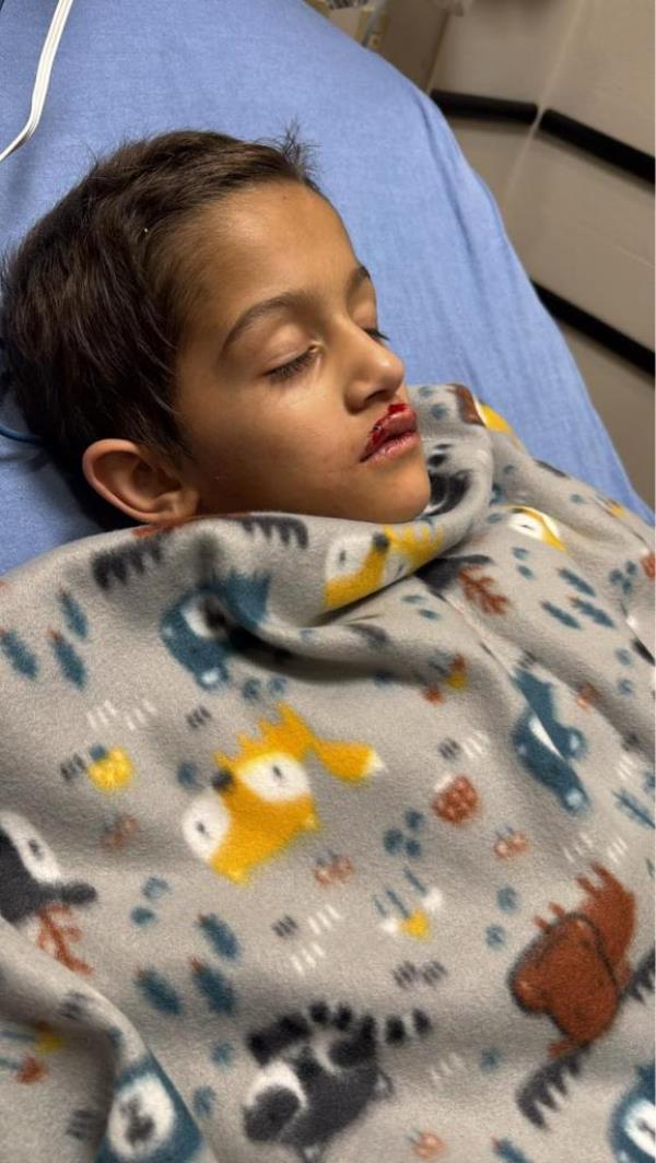 Young boy in hospital bed with bloody lip