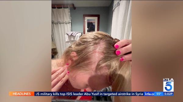 photo shows clumps of hair missing from Erin Quinn's scalp, taken from KTLA news