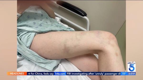 Photo shows bruises on Erin Quinn's legs from the Wednesday attack, which is taken from KTLA news